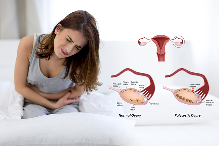 Polycystic Ovarian Syndrome Aquino Acupuncture Center For Holistic polycystic-ovarian-syndrome-aquino-acupuncture-center-for-holistic